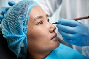 Korean Upper Blepharoplasty