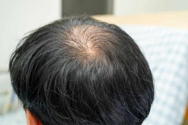 Techniques for Optimal Results: Comprehensive Hair Transplant and Restoration