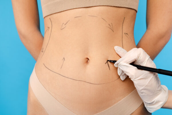 Aesthetic Body Contouring: Liposuction & Autologous Fat Transfer